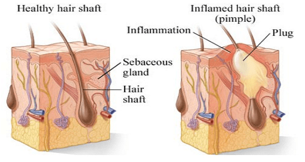 Acne-Inflammation-Image