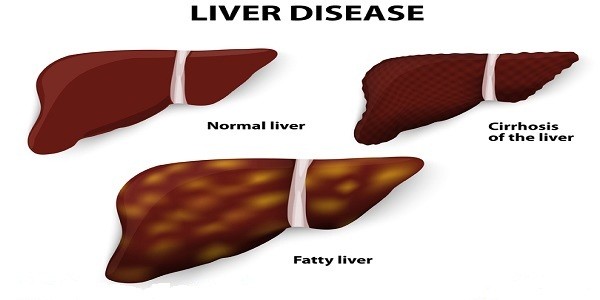 fatty-liver-symptoms-and-how-to-heal-them