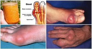 Say-Goodbye-To-Gout-Forever-With-This-Powerful-Natural-Treatment